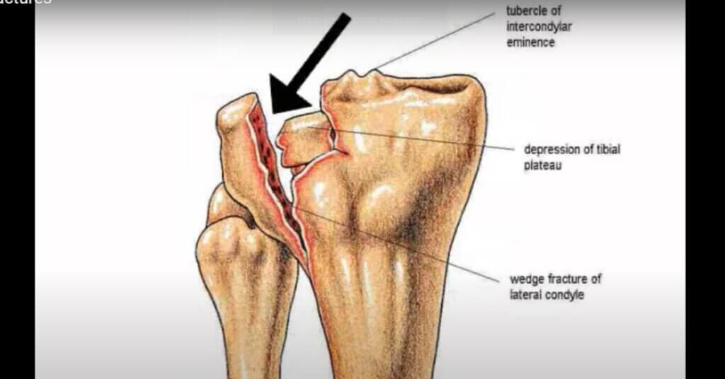 Knee Stress Fractures